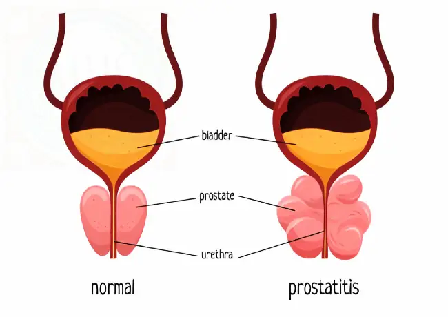 Prostatitis inflamation