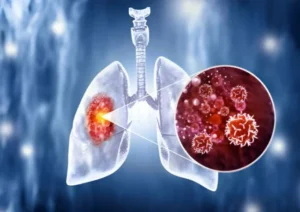 First stage of lung cancer (4)