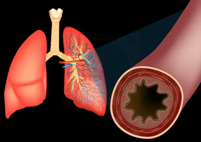 First stage of lung cancer