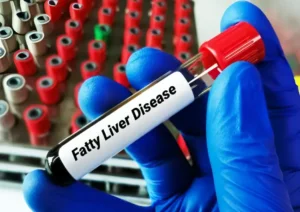 What is the fatty liver_ what is the treatment for fatty liver_ (2)