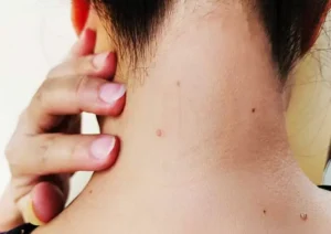 What Causes Warts and Moles (1)