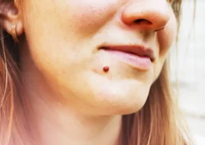What Causes Warts and Moles (2)