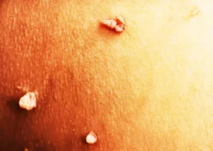 What Causes Warts and Moles (3)