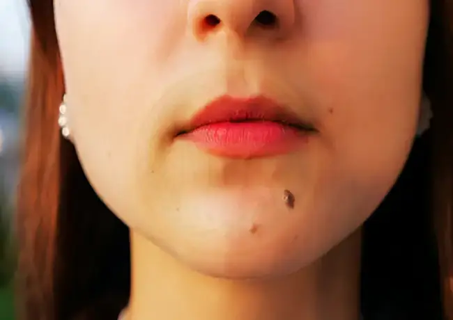 What Causes Warts and Moles