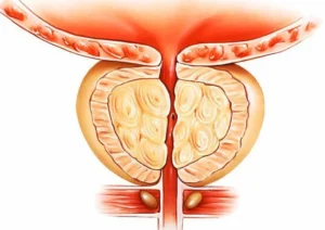 Prostatitis inflammation (2)