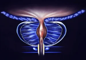 Prostatitis inflammation (3)
