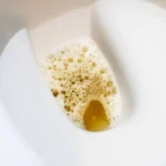 Foamy urine diabetes