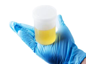 Foamy urine diabetes (3)