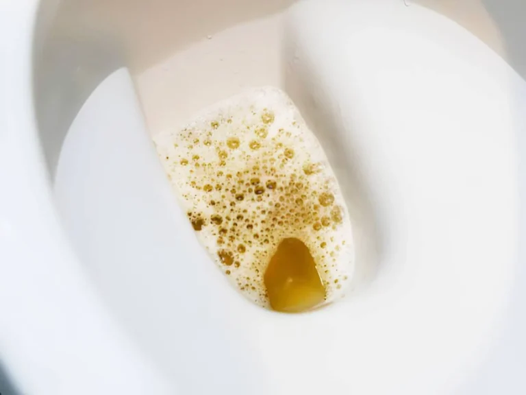 Foamy urine diabetes