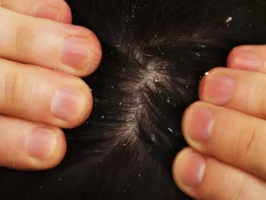 Dandruff in scalp and hair loss (1)