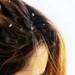 Dandruff in scalp and hair loss