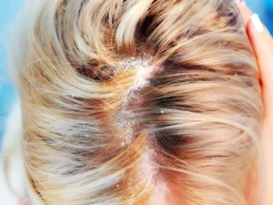 Dandruff in scalp and hair loss (2)