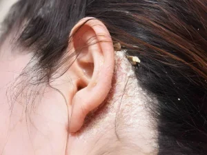 Dandruff in scalp and hair loss (3)
