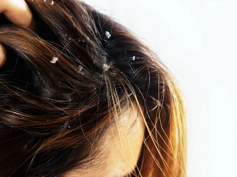 Dandruff in scalp and hair loss
