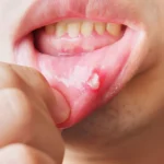 Mouth Ulcers_ Types, Causes, and When to Worry