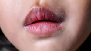 Mouth Ulcers_ Types, Causes, and When to Worry (2)