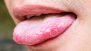 Mouth Ulcers_ Types, Causes, and When to Worry (3)