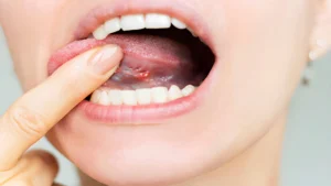 Mouth Ulcers_ Types, Causes, and When to Worry (4)