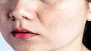 Pigmentation on face (1)