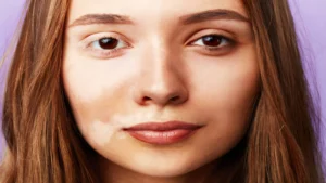 Pigmentation on face (3)