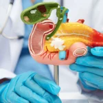 Pancreatic cancer causes